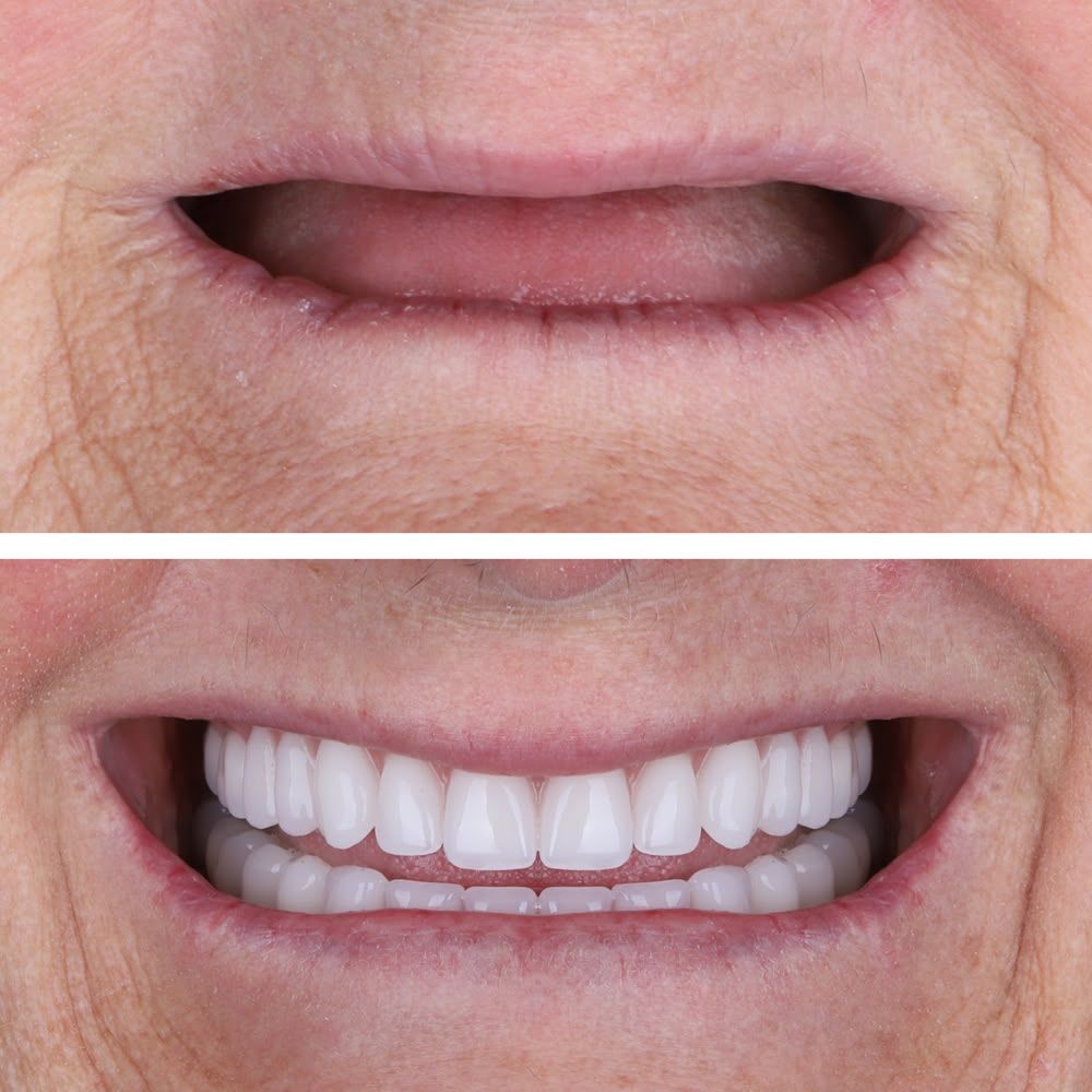 Reabilitação de sorriso sem dentes visíveis