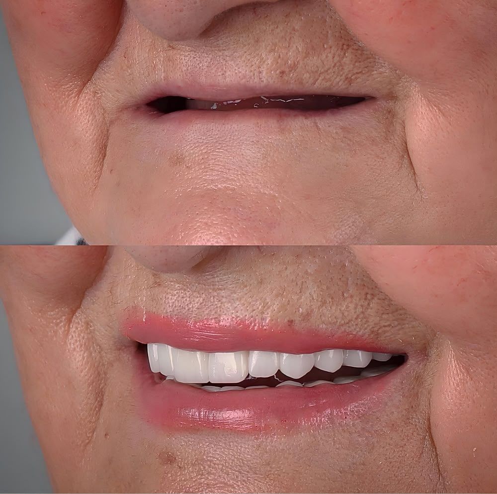 Reabilitação de sorriso sem dentes visíveis